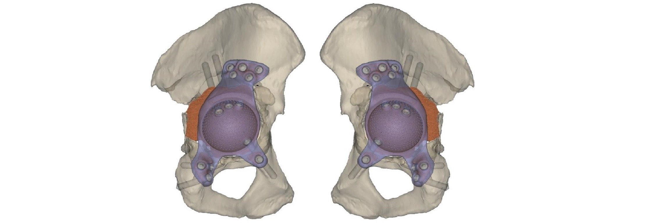 ORTHO Prjpapropsky Afb Bekken Resized