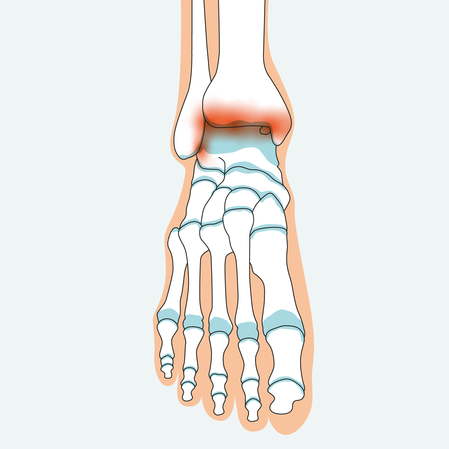 1.12 Kraakbeen Letsel